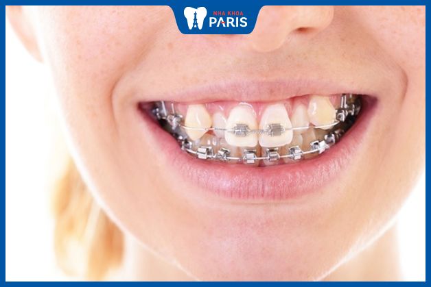 Khắc phục răng không đều bằng phương pháp chỉnh nha
