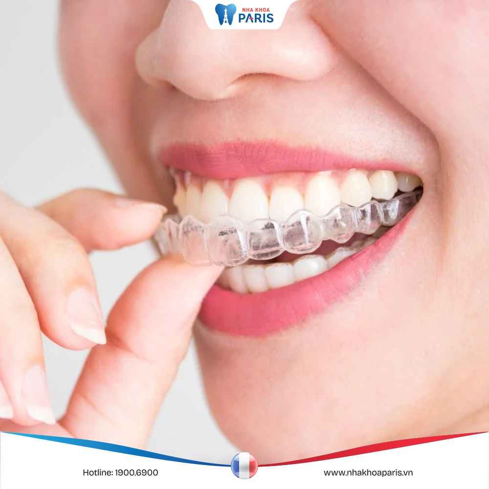 Niềng răng không mắc cài: Phân loại, ưu và nhược điểm