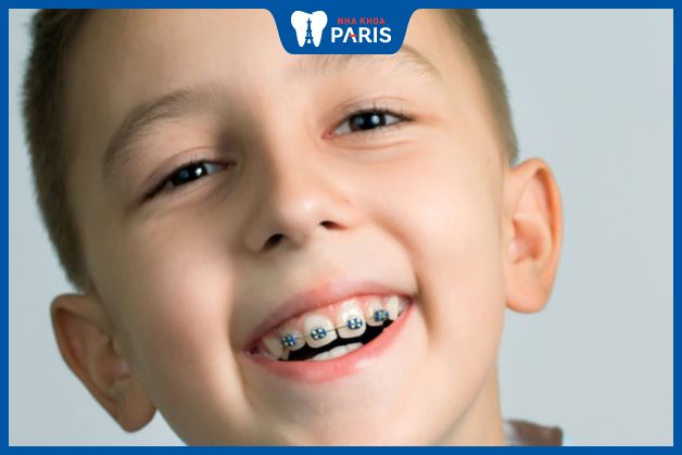 Trẻ em chỉnh nha thường không phải nhổ răng