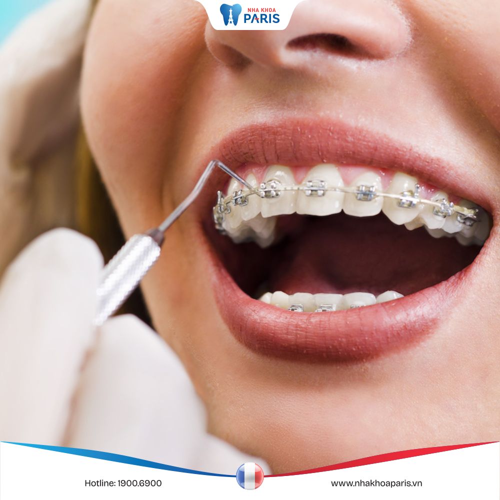Có nên niềng răng lại lần 2 không? Tư vấn, báo giá chi phí