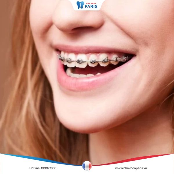 Niềng răng mắc cài kim loại là gì?ưu điểm nổi bật của mắc cài kim loại