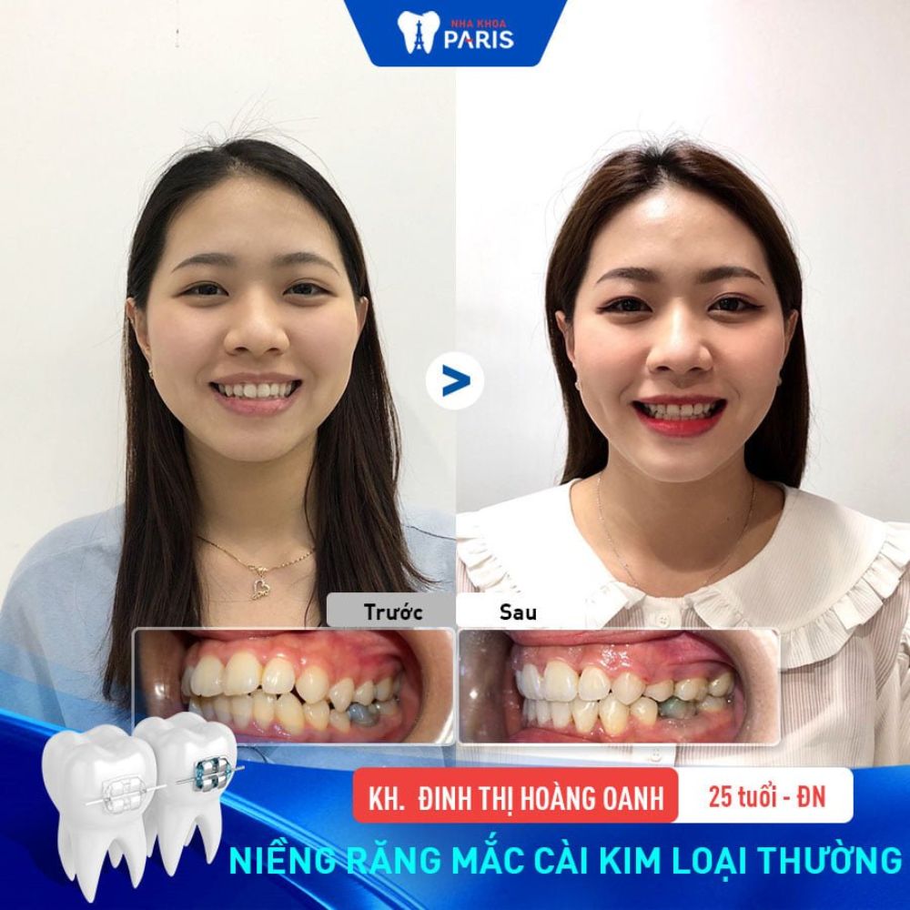Khách hàng niềng răng mắc cài kim loại tại Nha khoa Paris