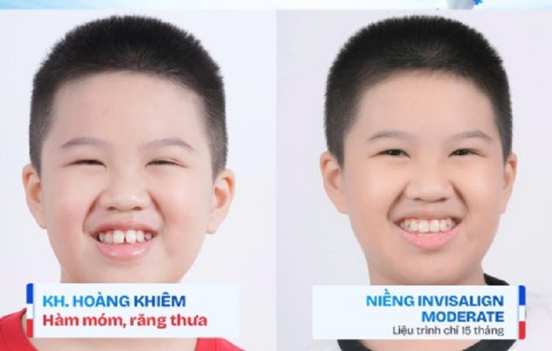 Thời gian niềng răng móm dao động từ vài tháng đến vài năm
