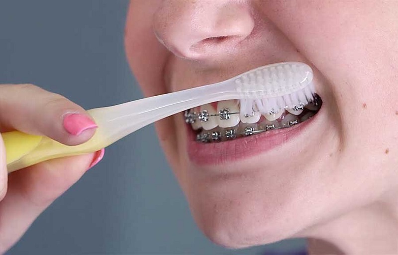 Vệ sinh răng miệng sạch sẽ theo hướng dẫn của bác sĩ