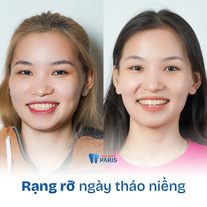 Với người lớn có thể kéo dài thời gian niềng răng hơn