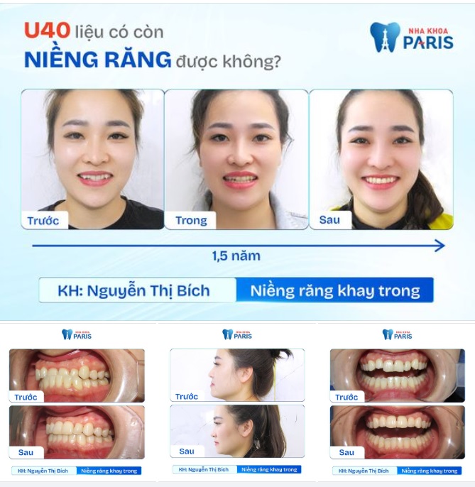 Kết quả sau 1.5 năm niềng răng của khách hàng Nguyễn Thị Bích