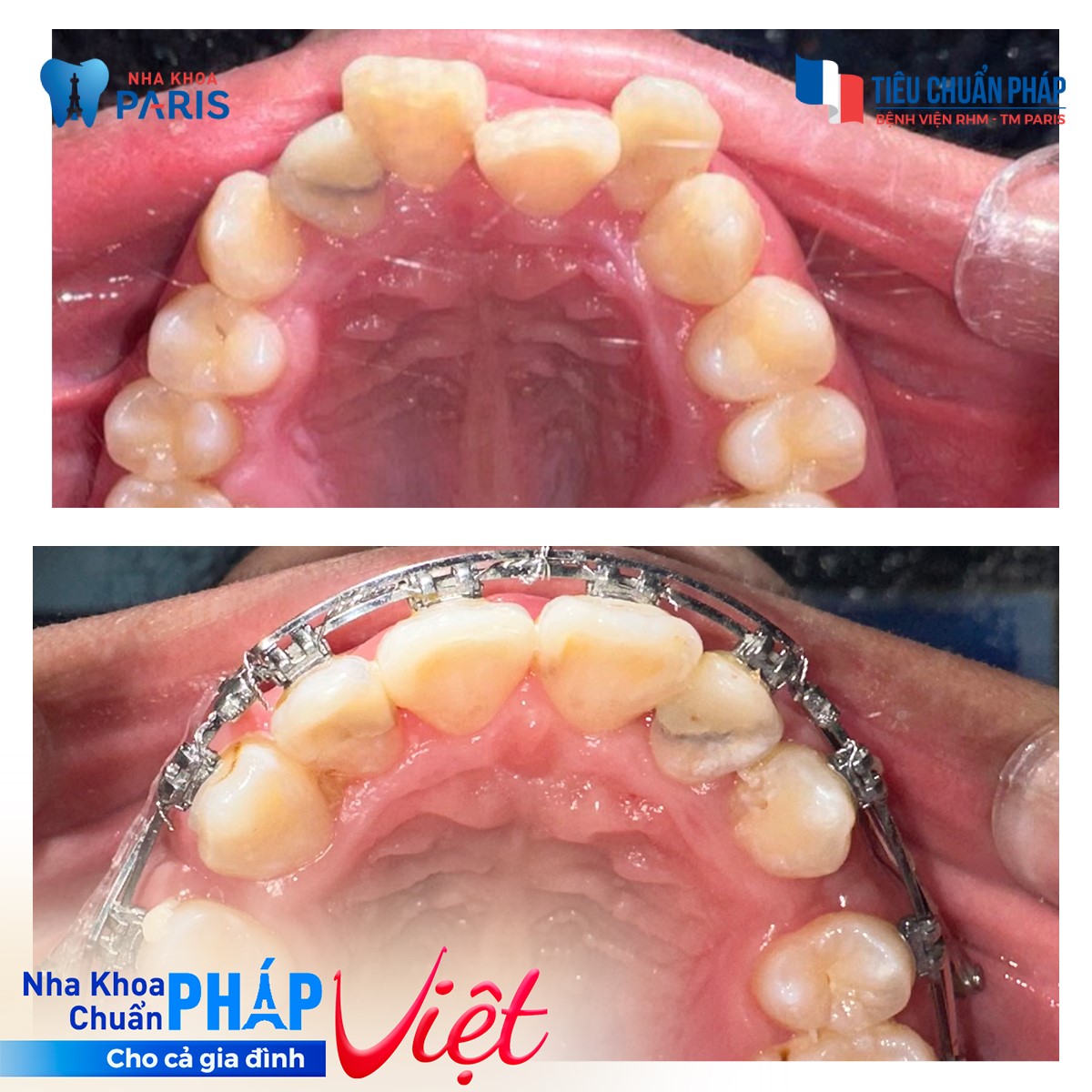 Chỉnh nha giúp nắn chỉnh răng mọc lệch