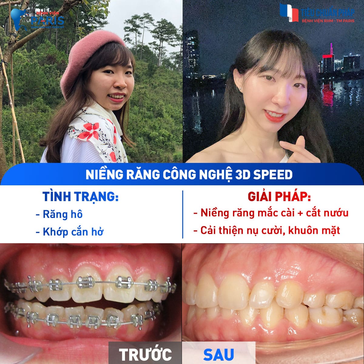 Chỉnh nha khắc phục khuyết điểm răng hô