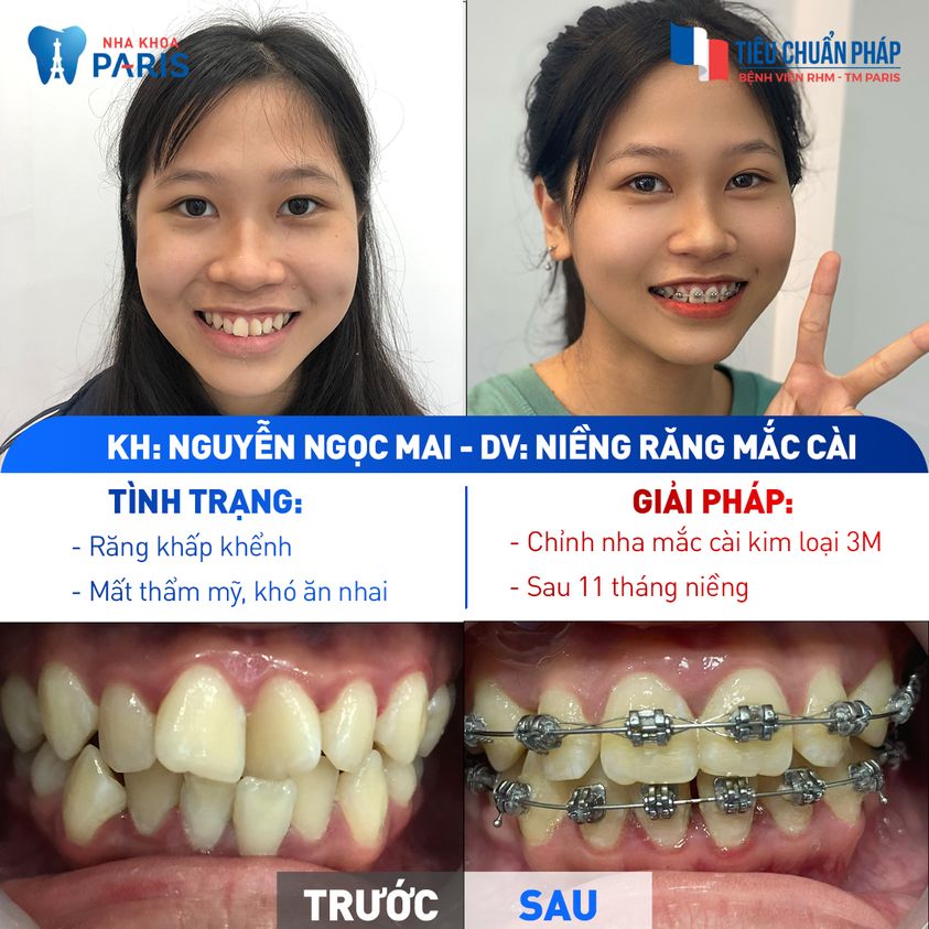 Chỉnh nha mắc cài kim loại