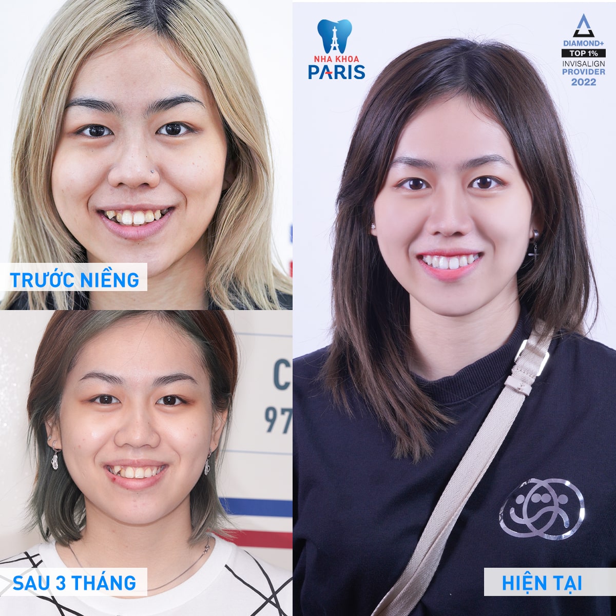 Khách hàng chỉnh nha tại Nha khoa Paris