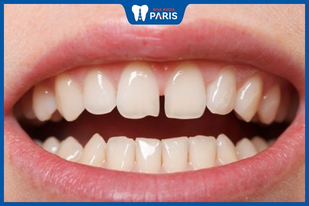 Răng thưa gây ảnh hưởng đến quá trình ăn nhai