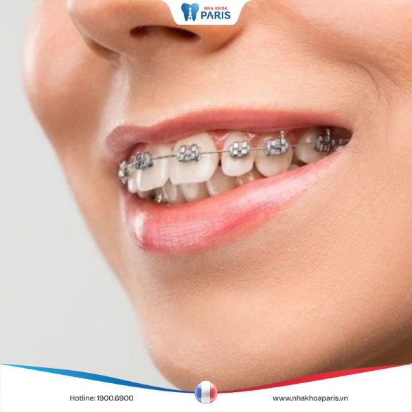 Niềng răng tiếng anh là gì? Các mẫu câu trao đổi với nha sĩ