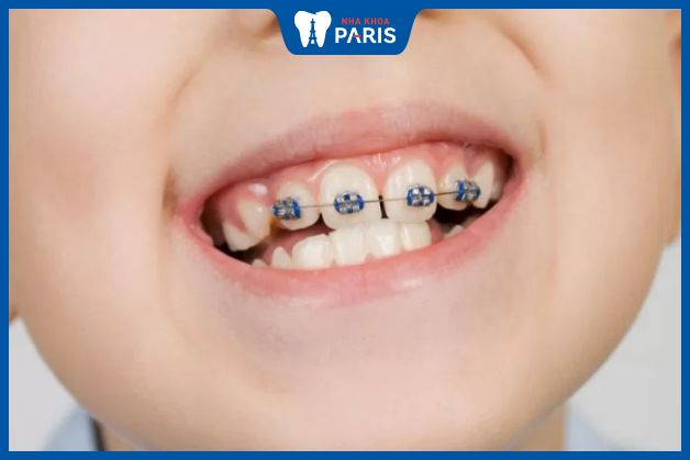 Quá trình niềng răng của trẻ nhanh hơn người lớn