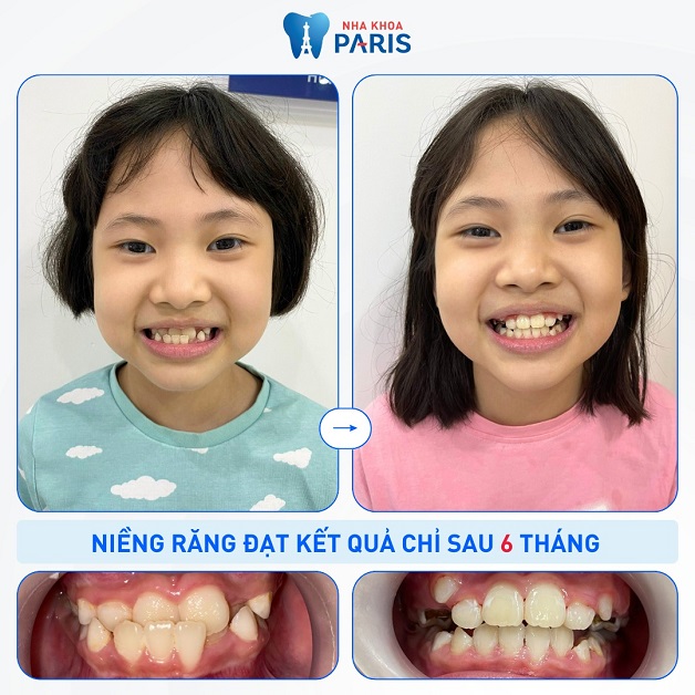 Bé Anh Thư sở hữu hàm răng khoẻ đẹp sau 6 tháng sử dụng dịch vụ niềng răng mắc cài kết hơp tranfore nong ngang tại Nha Khoa Paris