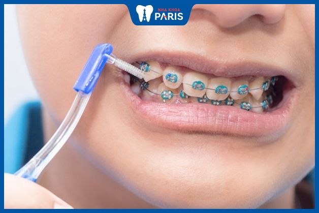 Có khoảng 5-15% bệnh nhân không hài lòng với kết quả niềng răng