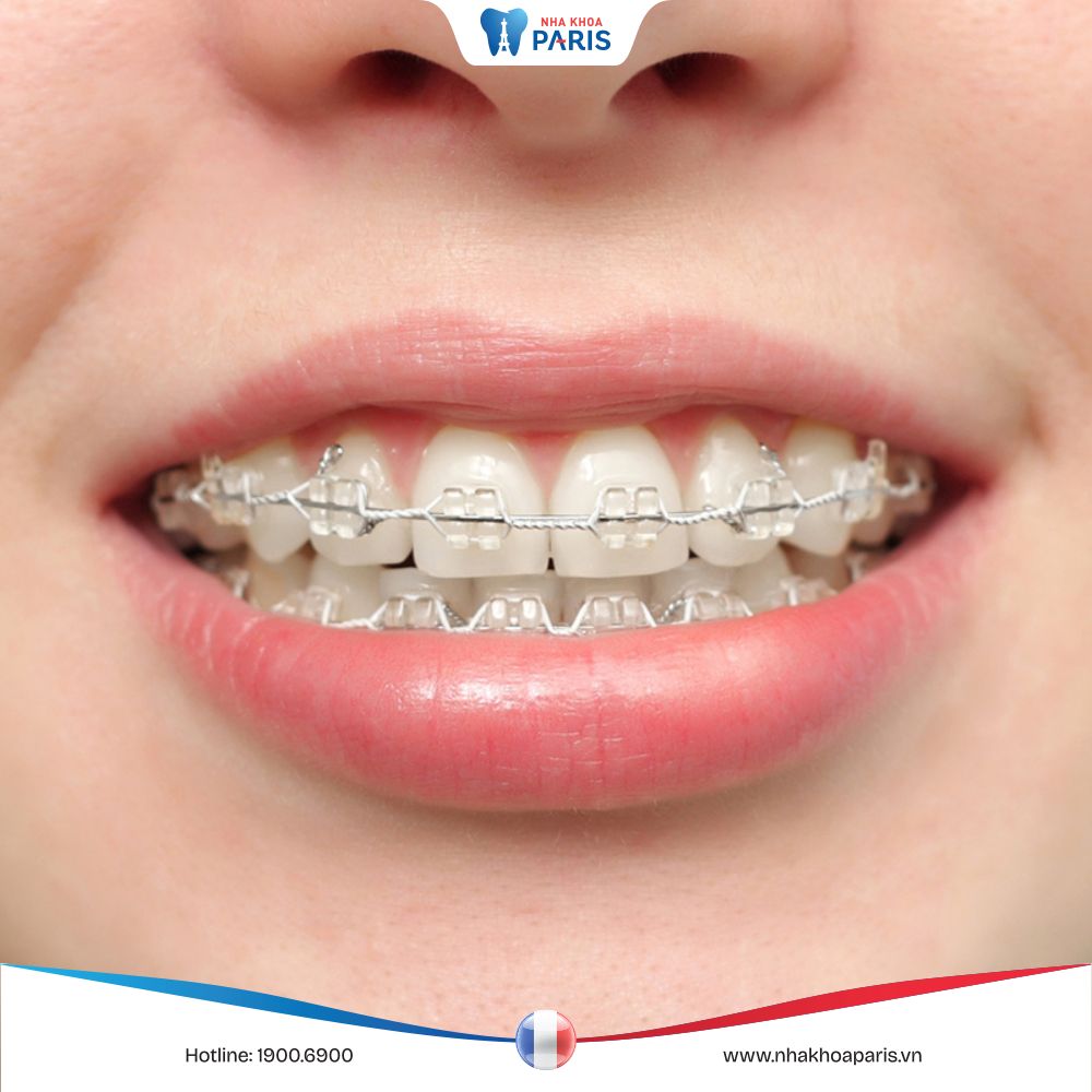 Niềng răng xong vẫn xấu: Nguyên nhân và giải pháp