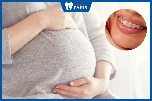 Chỉnh nha răng khểnh không dành cho phụ nữ có thai và cho con bú