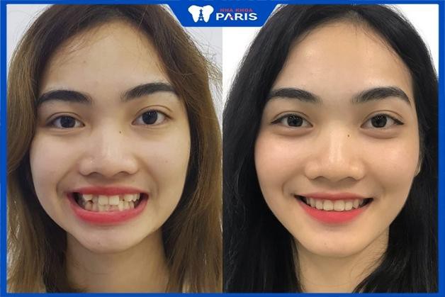Khách hàng Phương Thuý sau khi trải nghiệm niềng răng nanh tại Nha Khoa Paris
