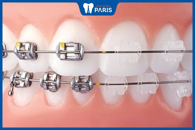 Dây cung thép không gỉ là một trong những loại dây cung được sử dụng phổ biến khi niềng răng
