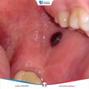 Nổi cục máu bầm trong miệng: Nguyên nhân và cách điều trị