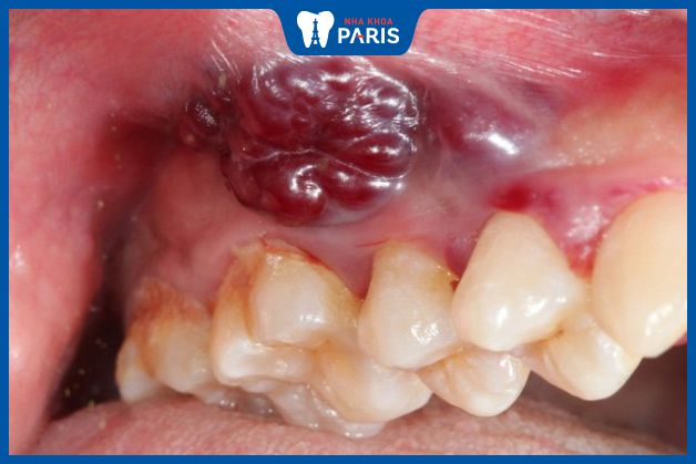 U máu trong miệng là tình trạng thường gặp và không cần điều trị
