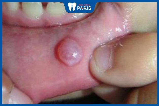Cục thịt trong miệng có màu hồng nhạt xuất hiện ở môi, má trong, không gây đau