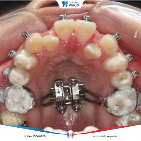 Nong hàm niềng răng – Đánh giá, phương pháp và lợi ích