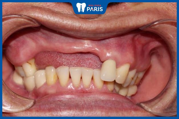 Mất răng toàn hàm do viêm nhiễm ở răng bị gãy lan rộng