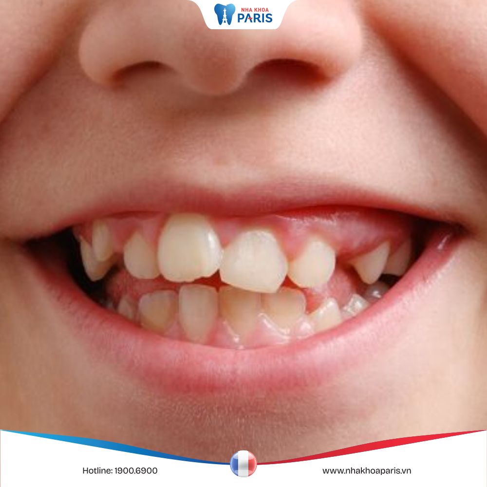 Răng bị lòi xỉ: Nguyên nhân, biểu hiện và cách điều trị