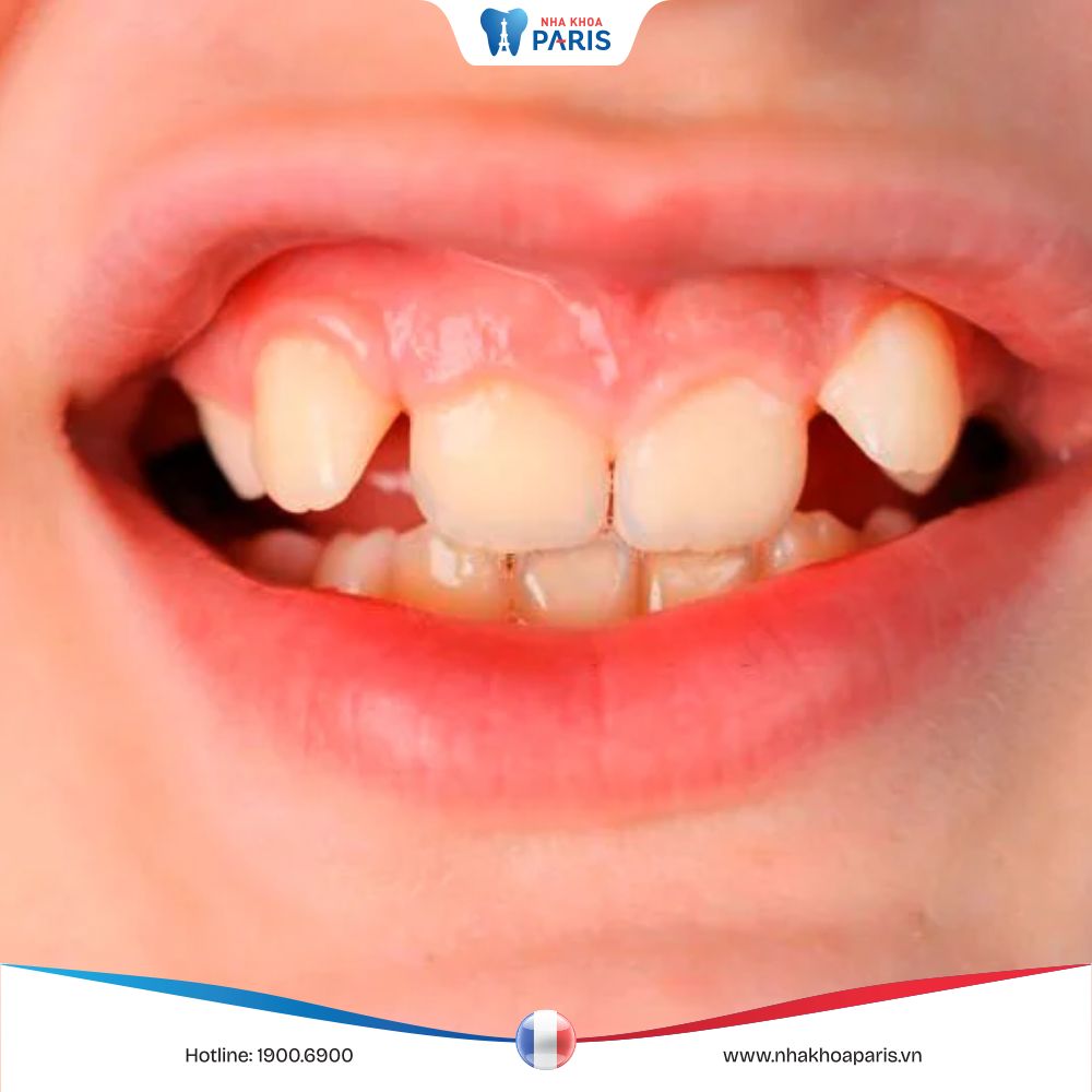 Răng chuột là như thế nào? Khắc phục tình trạng răng chuột