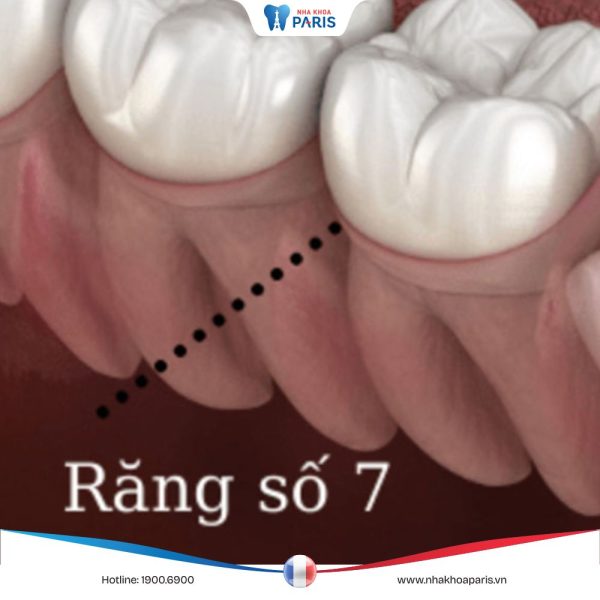 Răng hàm số 7 là răng nào? Hậu quả khi mất răng số 7