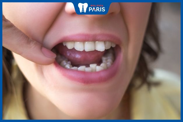 Răng khấp khểnh làm giảm khả năng ăn nhai nghiêm trọng