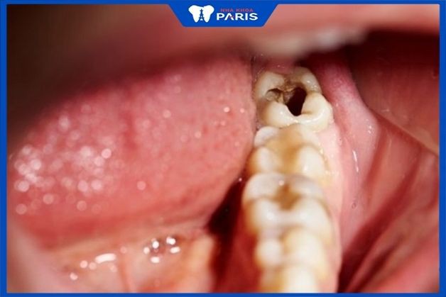 Sâu răng khôn xuất hiện lỗ lớn, bề mặt răng ngả vàng