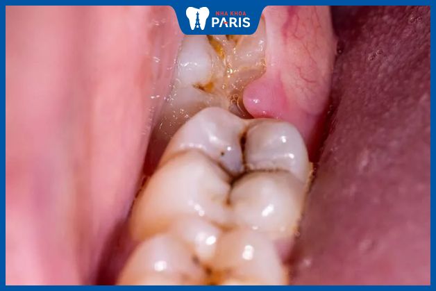 Sâu răng khôn do răng nằm ở vị trí khó tiếp cận, tạo điều kiện cho vi khuẩn phát triển