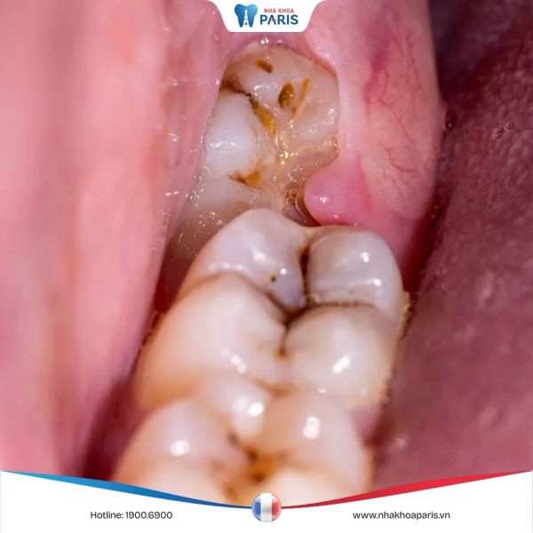 Răng khôn mọc lệch ra má: Nguyên nhân, dấu hiệu và cách xử lý