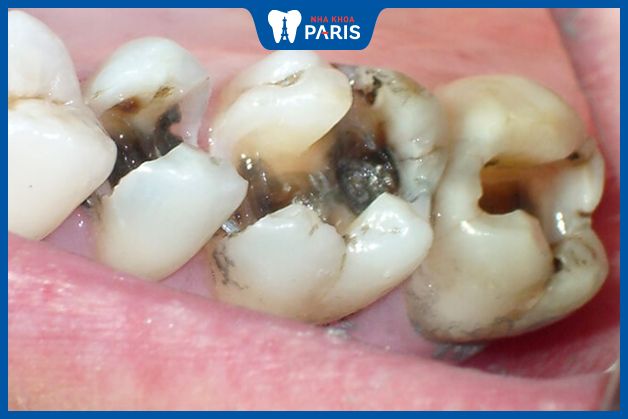 Răng sâu gây đau nhức do phá hủy cấu trúc răng