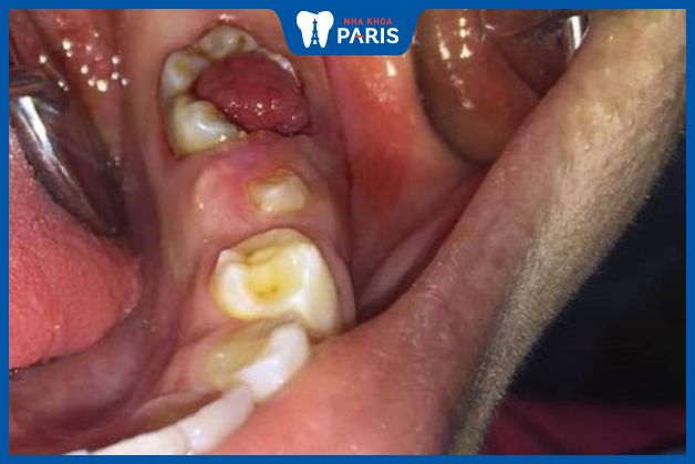 Răng sâu bị lồi thịt do bệnh sâu răng không chữa trị sớm