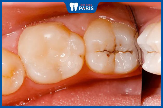Bệnh sâu răng cần được điều trị sớm