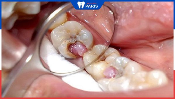 Nguyên nhân gây tình trạng sâu răng lồi thịt? Biện pháp điều trị hiệu quả