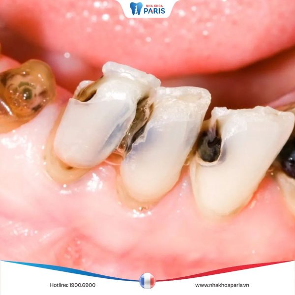 Răng sâu vào tuỷ: Nguyên nhân, triệu chứng và cách điều trị