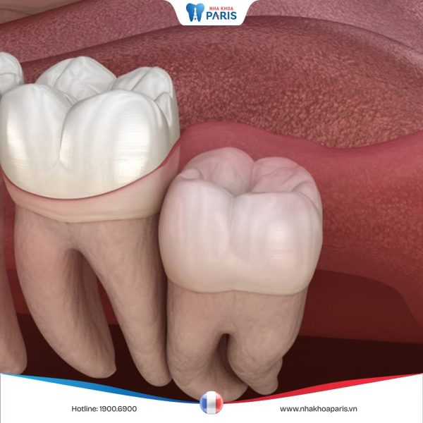Răng số 4 và 48 là răng nào? Nhổ đi có ảnh hưởng gì không?