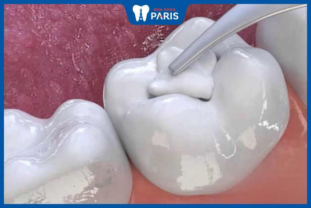 Hàn trám răng hàm số 5 được áp dụng khi sâu răng chưa ăn vào tuỷ