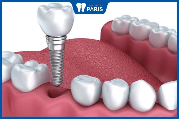 Trụ Implant bằng titanium cắm vào xương hàm tại vị trí răng cối số 5 đã mất 