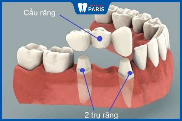 Mô tả sử dụng cầu răng để phục hình răng hàm số 5