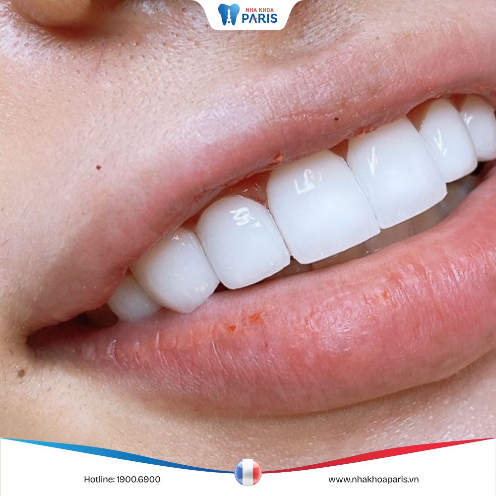 Răng sứ Cercon là gì? Quy trình bọc răng sứ Cercon an toàn