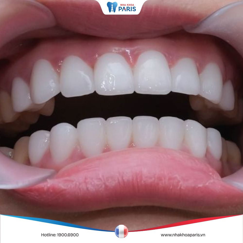 Tìm hiểu về răng sứ Katana: Nguồn gốc và các ưu nhược điểm