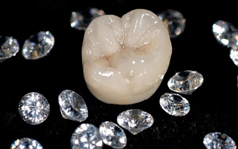 Tuổi thọ cao là ưu điểm nổi bật của răng sứ Diamond