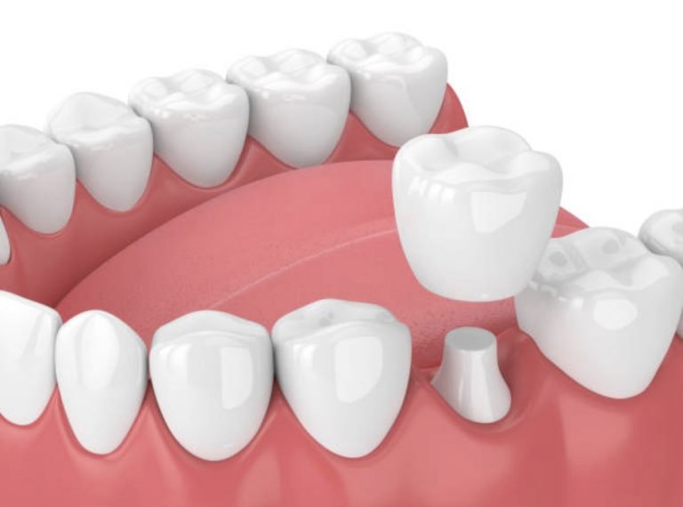 Bọc răng sứ kim cương không gây đau do được gây mê trước khi thực hiện