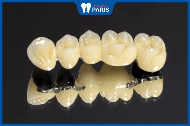 Răng sứ kim loại có độ cứng chắc cao, chịu lực tốt