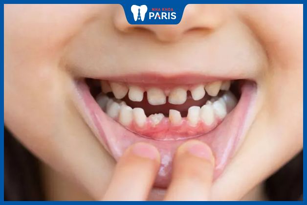 Răng sữa của bé mọc lệch do răng và hàm không cân xứng
